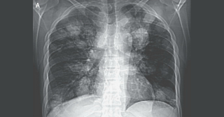 Illustration for article titled Horrified Doctors Find "Crazy" Tapeworm Cancer in Patient’s Brain